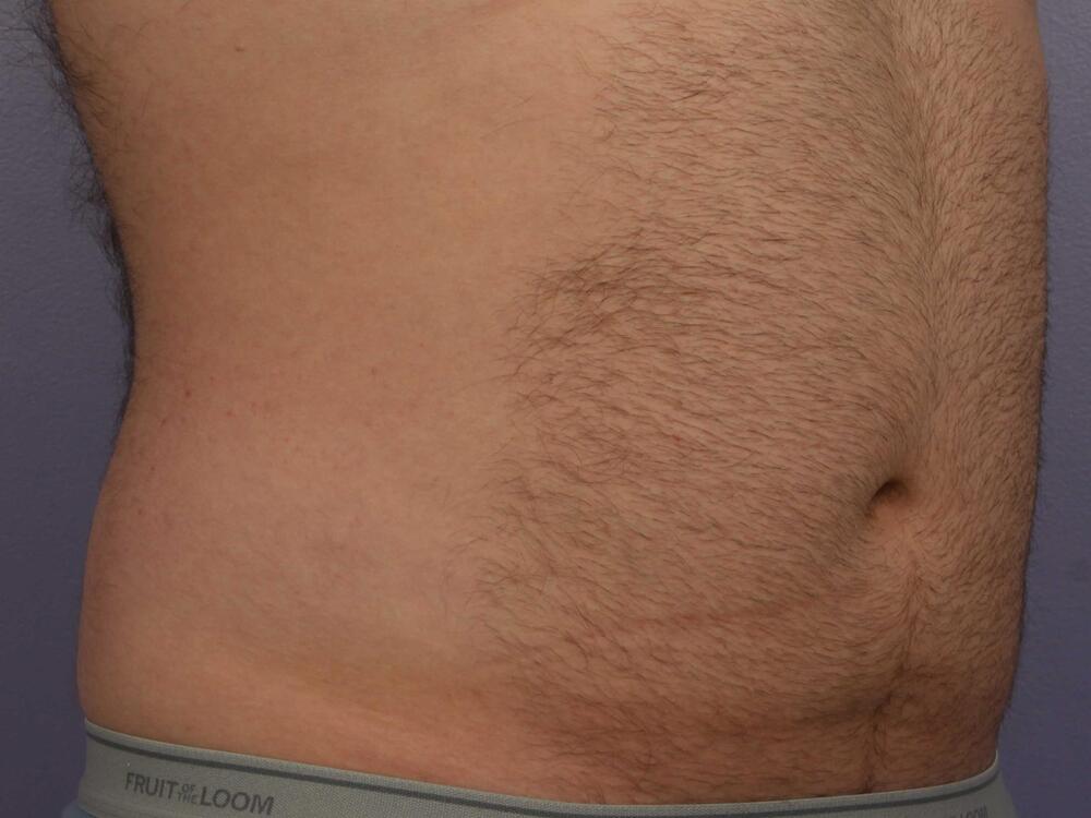 CoolSculpting Before & After Image