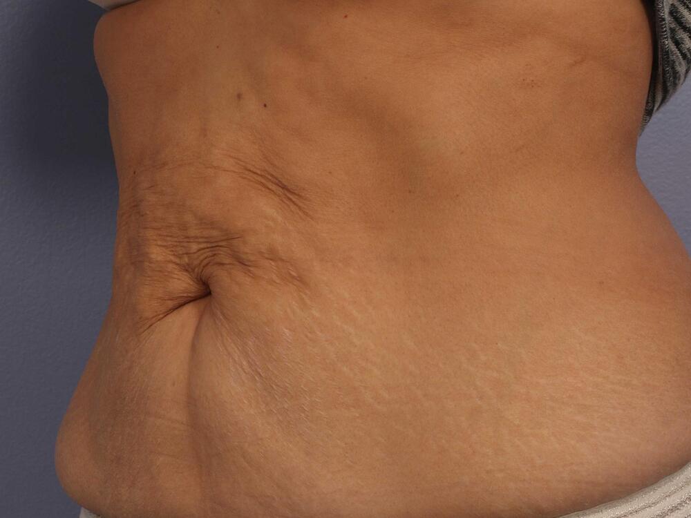 CoolSculpting Before & After Image