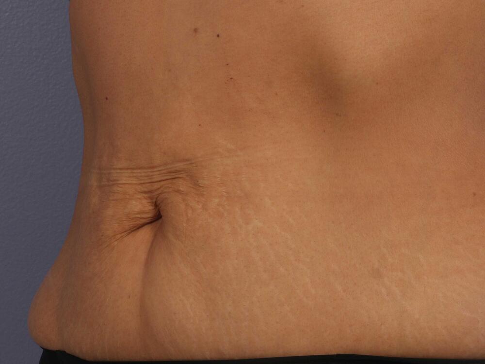 CoolSculpting Before & After Image