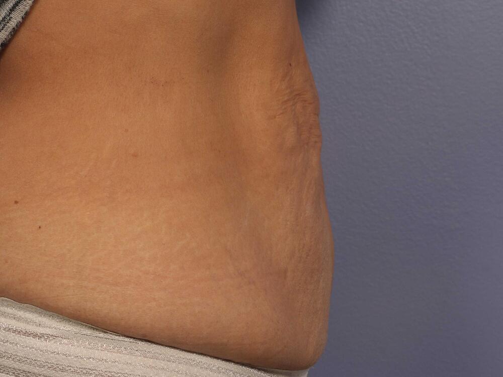 CoolSculpting Before & After Image