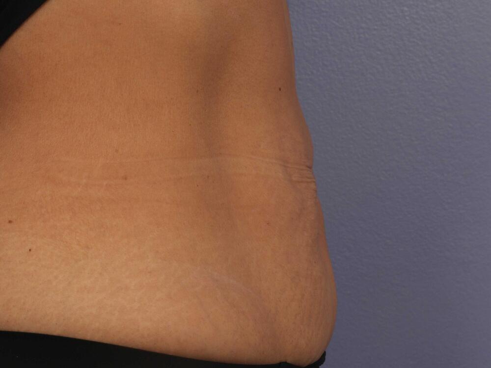 CoolSculpting Before & After Image