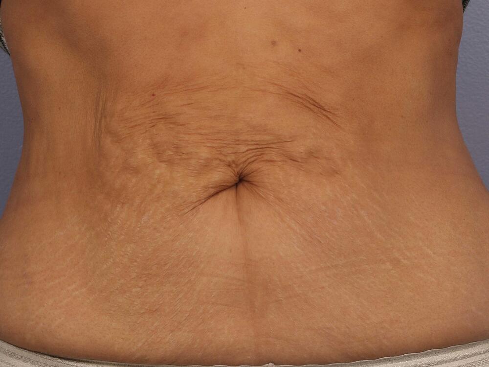 CoolSculpting Before & After Image