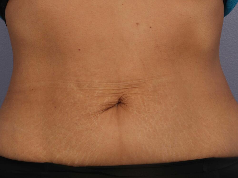 CoolSculpting Before & After Image