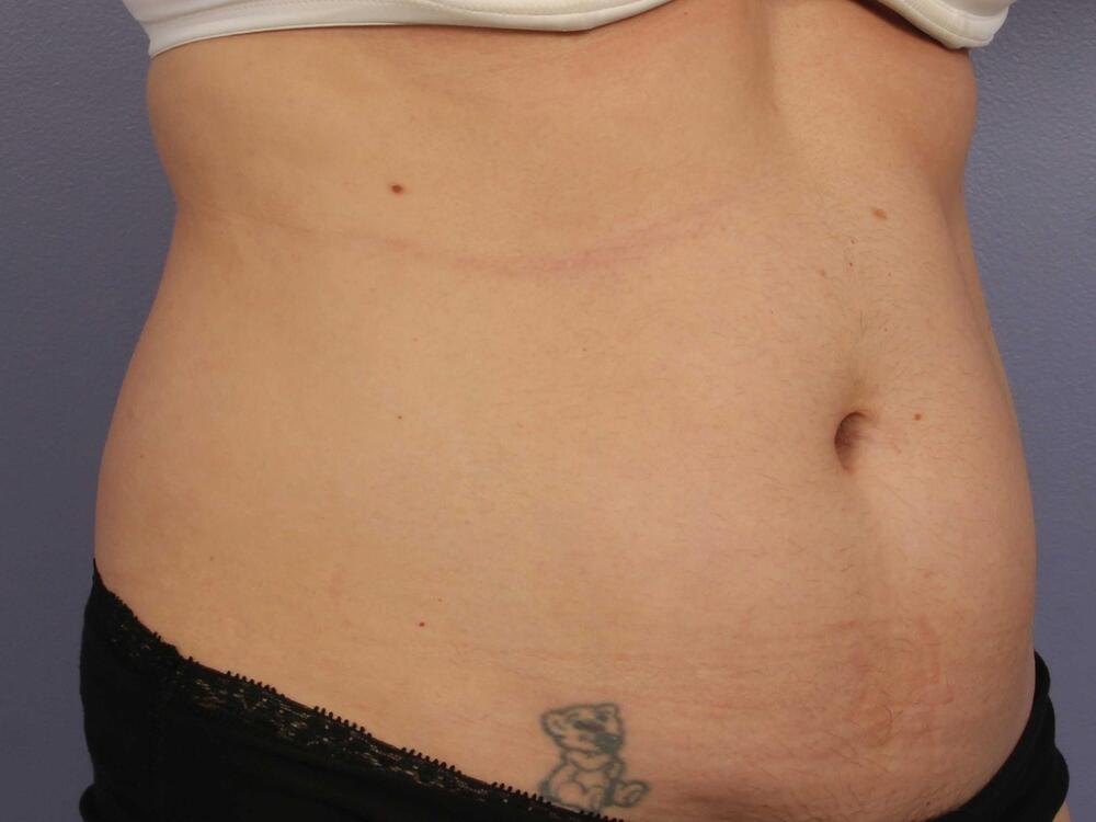 CoolSculpting Before & After Image