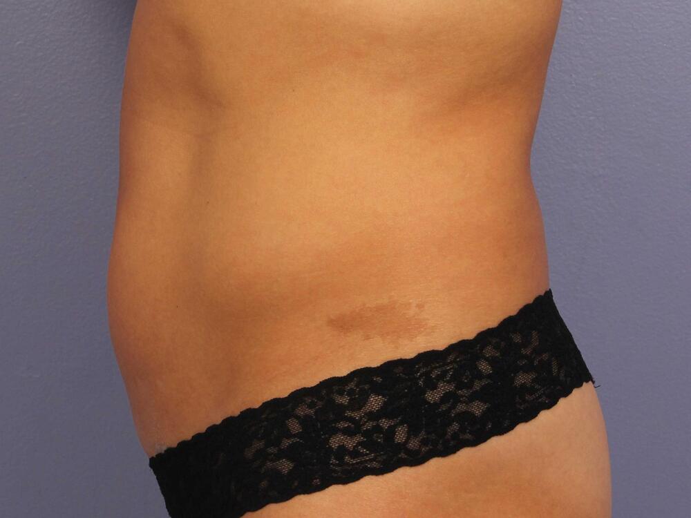 CoolSculpting Before & After Image