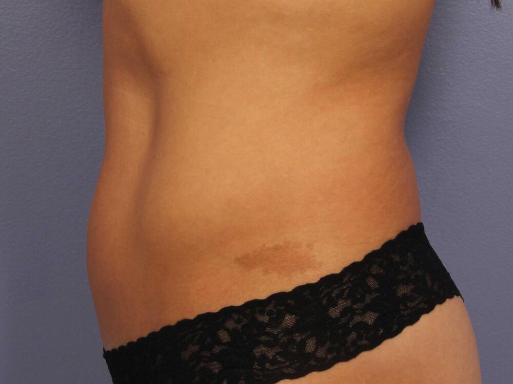 CoolSculpting Before & After Image