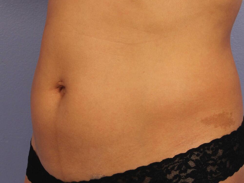 CoolSculpting Before & After Image