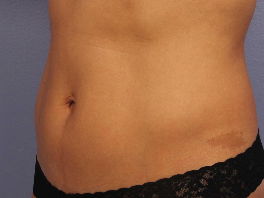 CoolSculpting Before & After Image