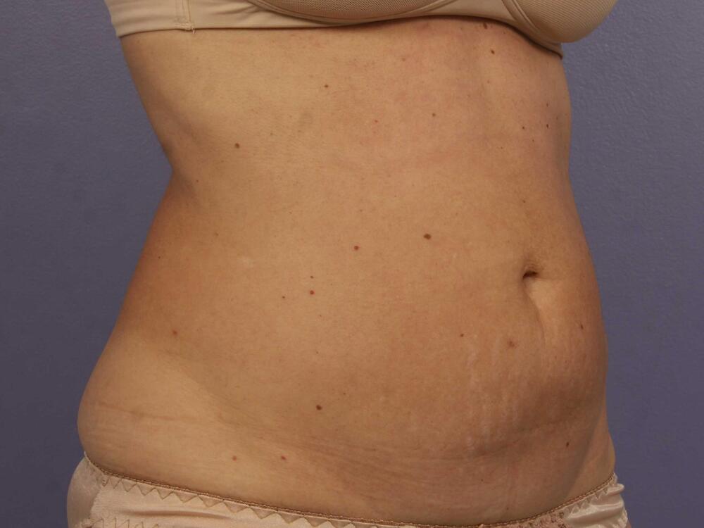 CoolSculpting Before & After Image