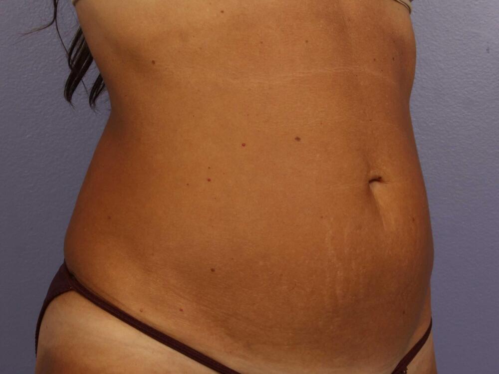 CoolSculpting Before & After Image