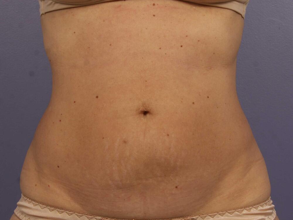 CoolSculpting Before & After Image