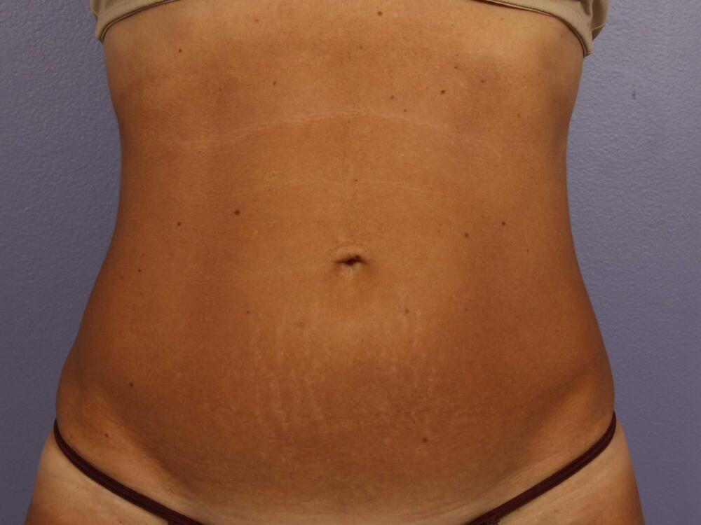 CoolSculpting Before & After Image