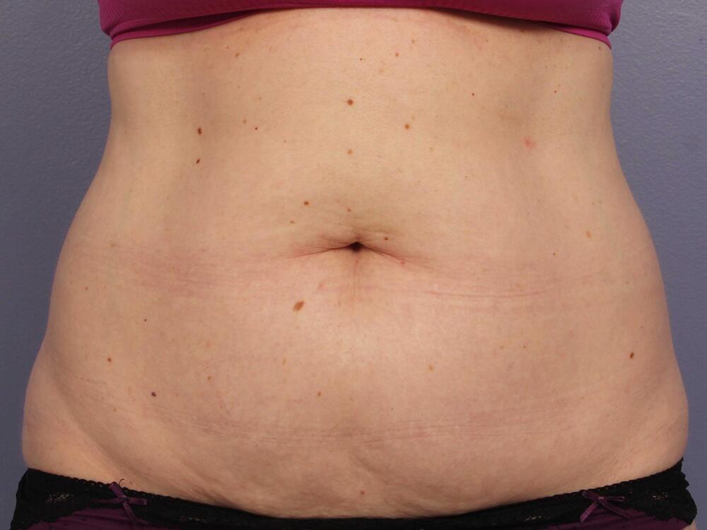 CoolSculpting Before & After Image