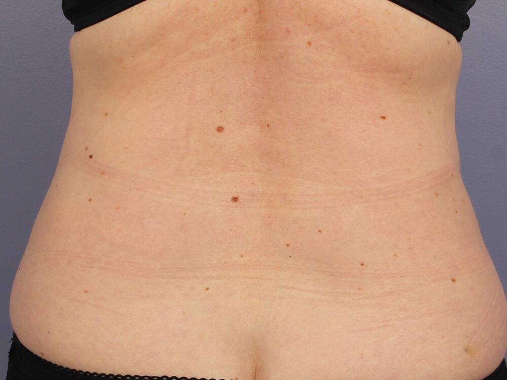 CoolSculpting Before & After Image