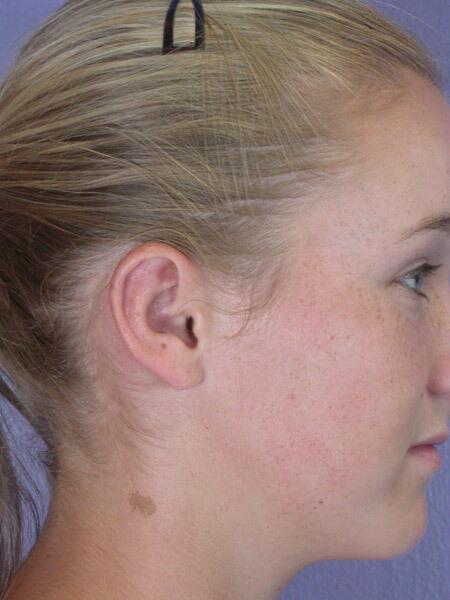 Ear Surgery Before & After Image