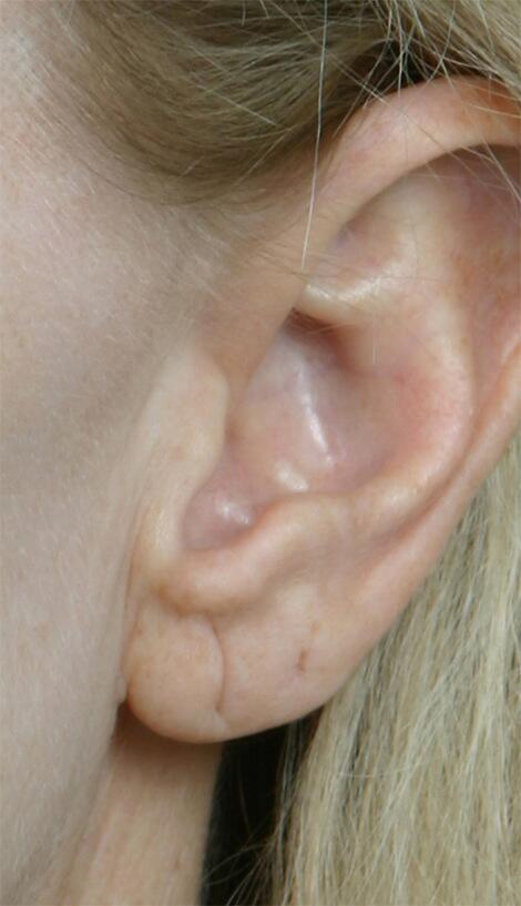 Ear Surgery Before & After Image