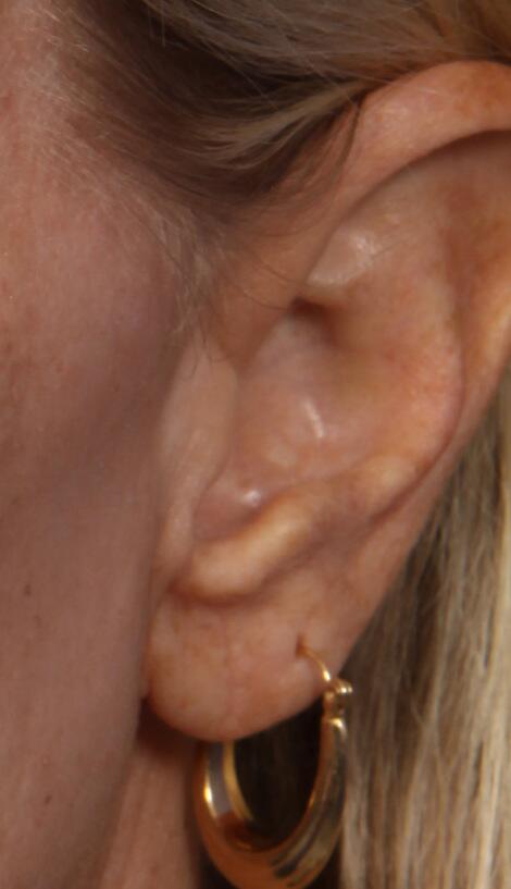 Ear Surgery Before & After Image