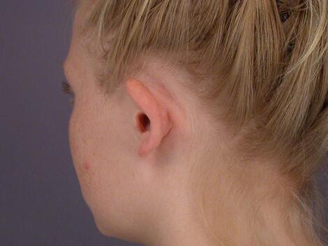 Ear Surgery Before & After Image