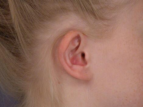 Ear Surgery Before & After Image