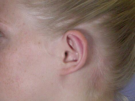 Ear Surgery Before & After Image