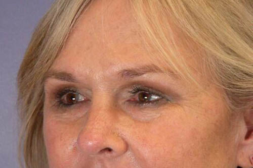 Eyelid Surgery Before & After Image