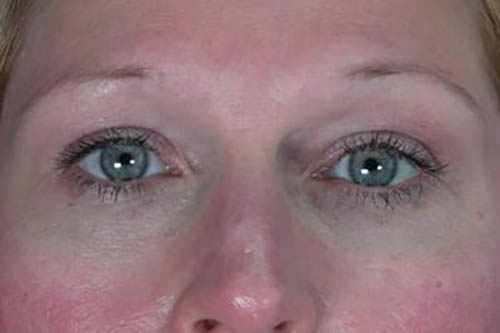 Eyelid Surgery Before & After Image