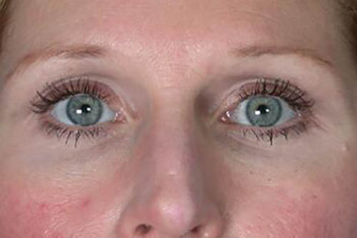 Eyelid Surgery Before & After Image