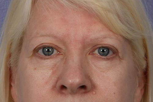 Eyelid Surgery Before & After Image