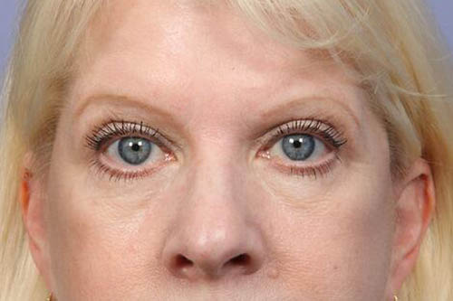 Eyelid Surgery Before & After Image