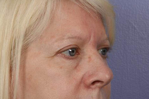 Eyelid Surgery Before & After Image