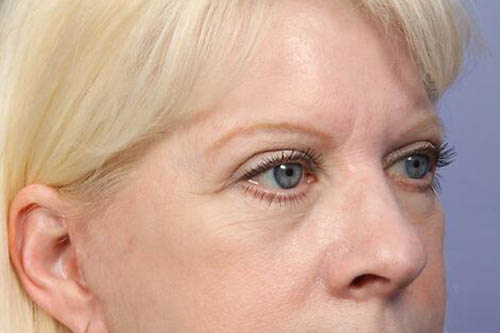 Eyelid Surgery Before & After Image