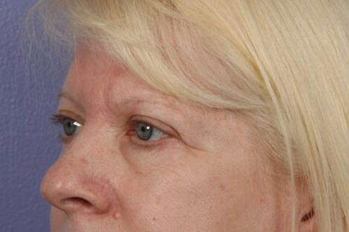 Eyelid Surgery Before & After Image