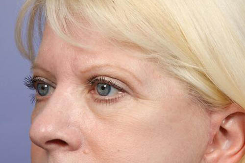 Eyelid Surgery Before & After Image