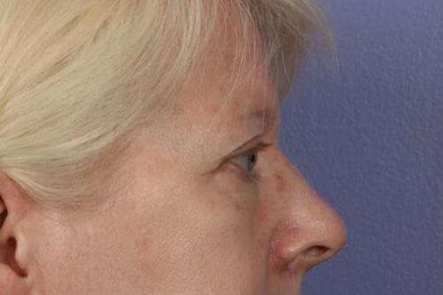 Eyelid Surgery Before & After Image