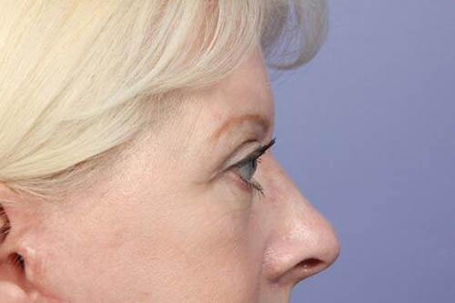 Eyelid Surgery Before & After Image