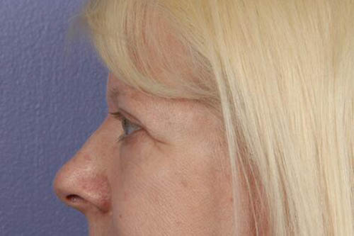 Eyelid Surgery Before & After Image