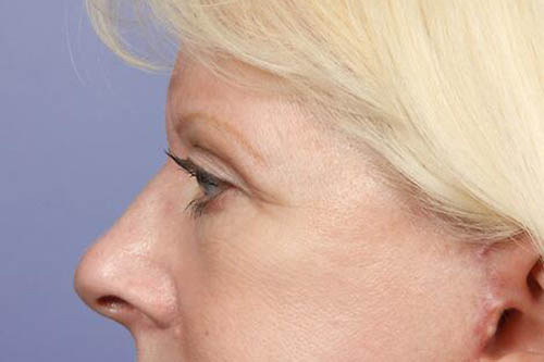 Eyelid Surgery Before & After Image