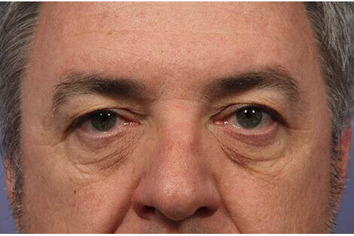 Eyelid Surgery Before & After Image