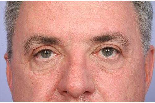 Eyelid Surgery Before & After Image