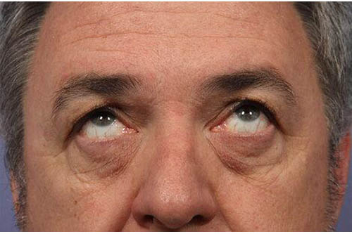 Eyelid Surgery Before & After Image