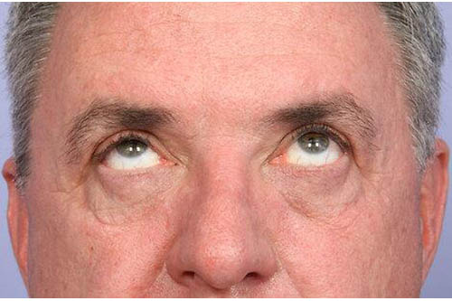 Eyelid Surgery Before & After Image