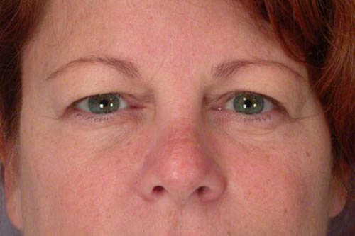 Eyelid Surgery Before & After Image