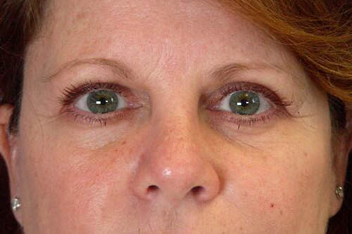 Eyelid Surgery Before & After Image