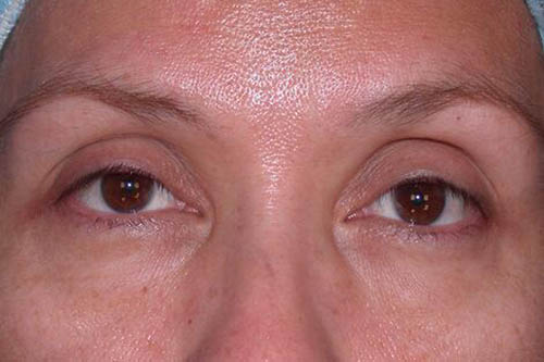 Eyelid Surgery Before & After Image