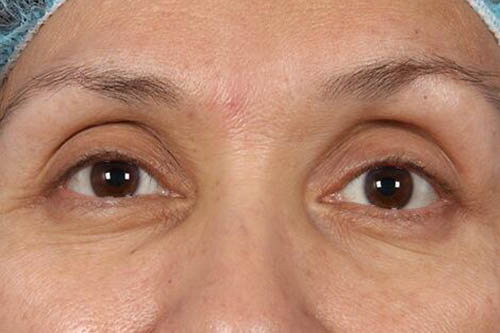 Eyelid Surgery Before & After Image