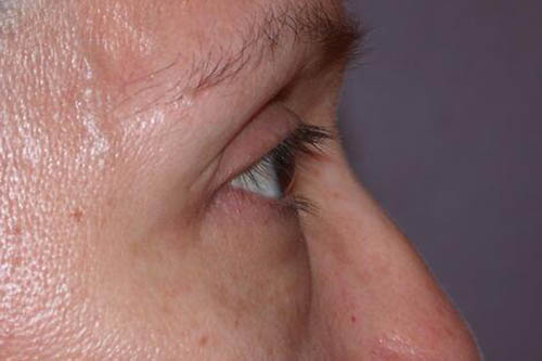 Eyelid Surgery Before & After Image