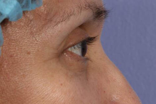 Eyelid Surgery Before & After Image