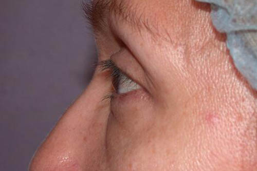 Eyelid Surgery Before & After Image