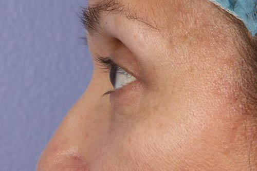 Eyelid Surgery Before & After Image