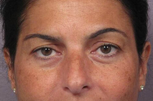 Eyelid Surgery Before & After Image